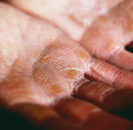 A dry hand with wrinkles