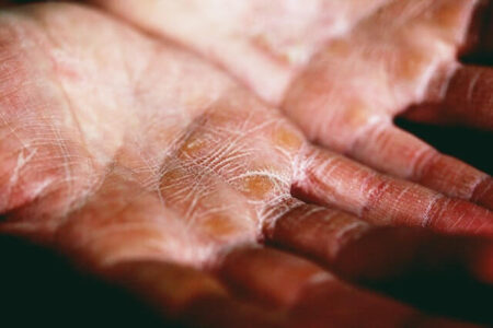 A dry hand with wrinkles
