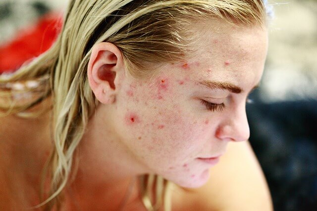 Face with acne breakouts